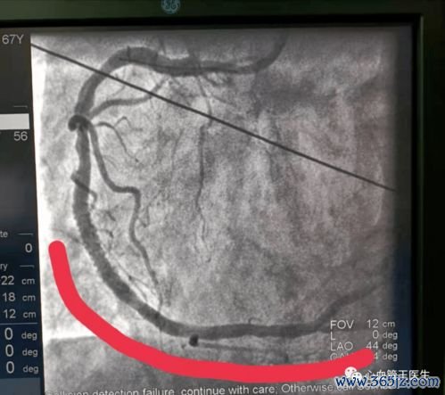 心肌梗死术后饮食：心脏支架后怎么吃才能防复发？