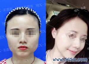 脸部,整形,手术,方式,轮廓