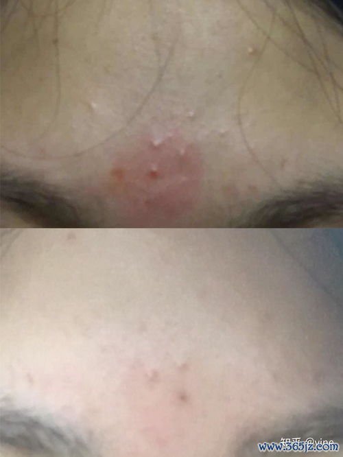 艾草贴肚脐真的可以减肥吗，亲测一个月的效果分享