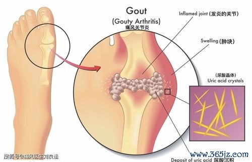 关节炎,肠病,炎症,性肠,病伴