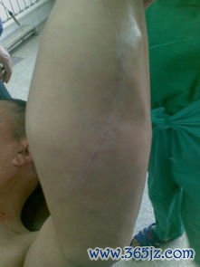 肥大细胞增生症-色素性荨麻疹，Darier征阳性