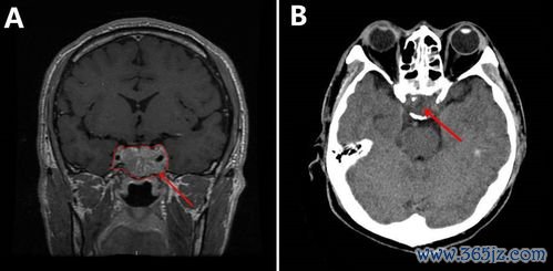 垂体瘤：脑子里长瘤子，影响激素分泌