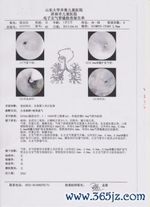 后穹窿积液量多少算正常需要抽出来吗