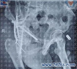 后穹窿积液需要治疗吗