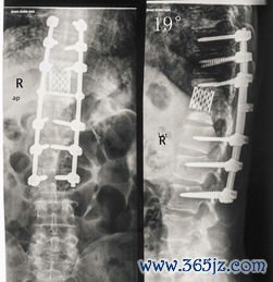 后穹窿积液需要治疗吗