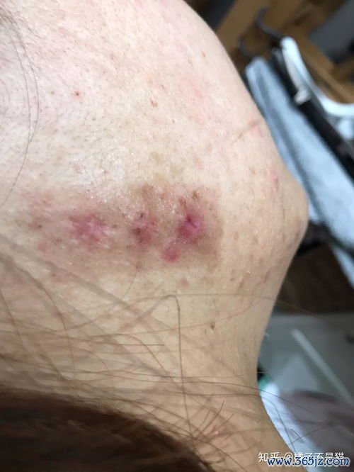 增生性疤痕：疤痕凸起