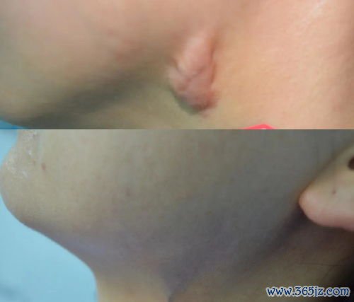 增生性疤痕：疤痕凸起