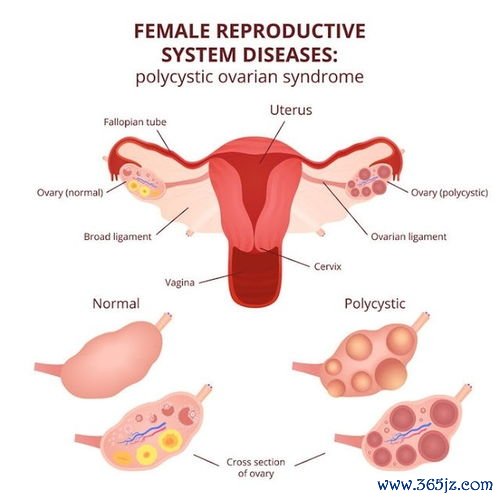 多囊卵巢综合征：月经不来、长毛、长痘、怀不上——内分泌的事儿