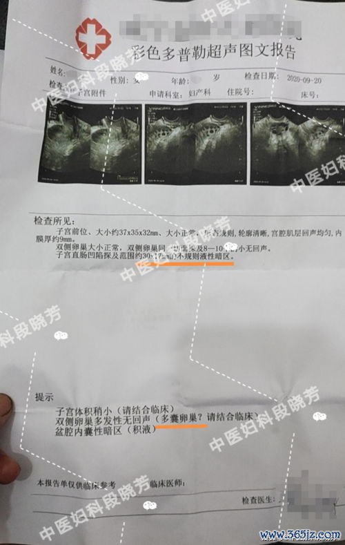 多囊卵巢综合征：月经不来长毛长痘怀不上，内分泌的事儿