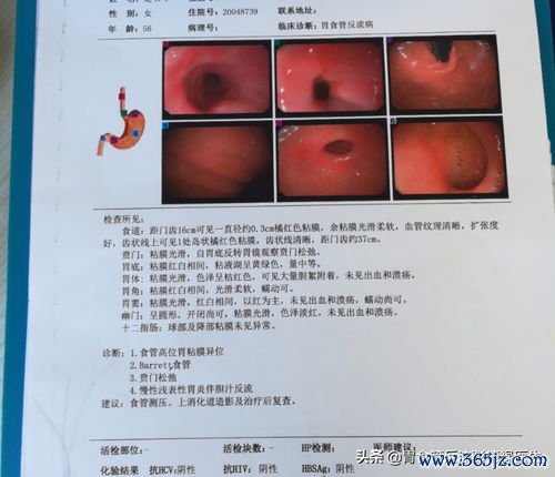 慢性胃炎食谱三餐这样安排胃不痛不胀不反酸 慢性胃炎食谱三餐这样安排胃不痛不胀不反酸