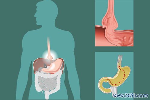 慢性胃炎食谱三餐这样安排胃不痛不胀不反酸 慢性胃炎食谱三餐这样安排胃不痛不胀不反酸