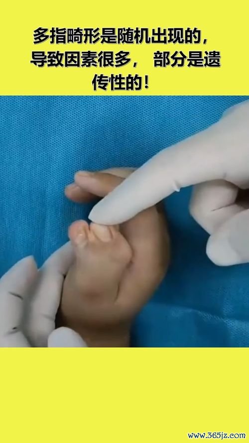 多指畸形：多长的手指切掉
