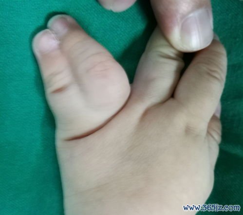 多指畸形：多长的手指切掉