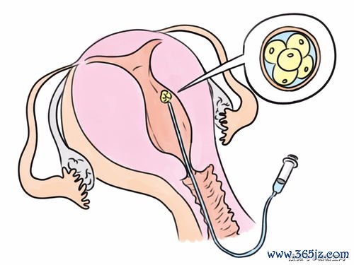 做试管婴儿好吗
