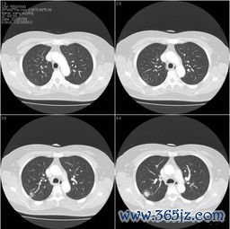 垂体性闭经做什么检查泌乳素高还是垂体瘤