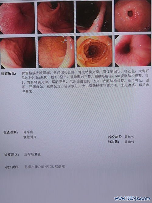 慢性胃炎食谱：三餐怎么安排，胃不难受？