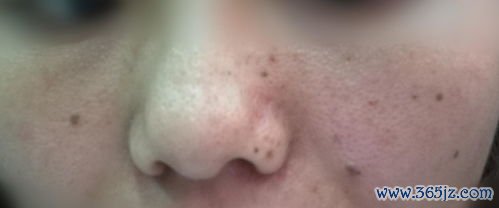 手术后吃什么伤口愈合快不留疤