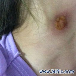 手术后吃什么伤口愈合快不留疤