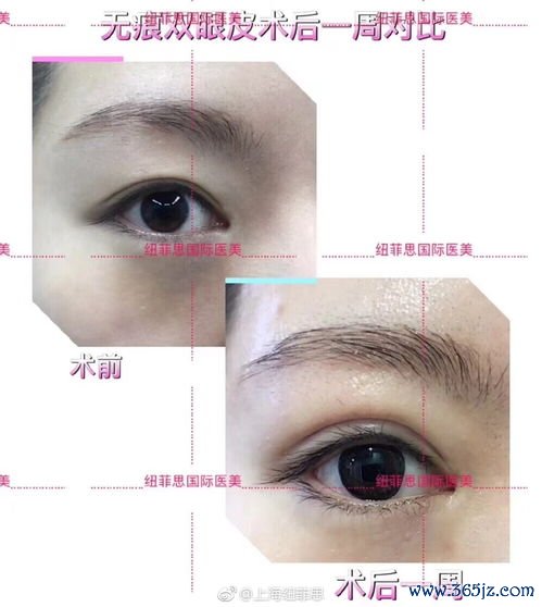 整形,韩美,医院,谱吗,韩国