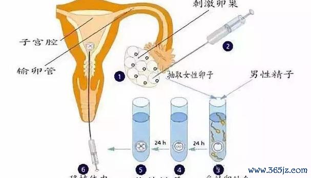 做试管婴儿如何取卵