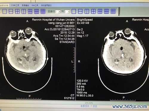 处女膜破了会流多少血