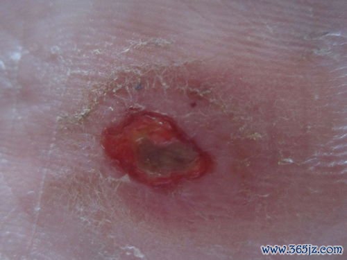 升药提脓，九一丹