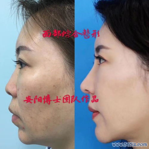 鼻头,整形,手术,方式,鼻翼