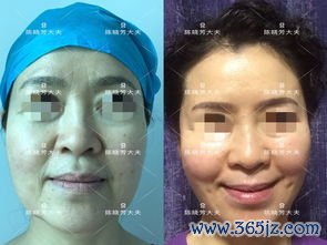 面部,美容整形,手术,方式,年轻化
