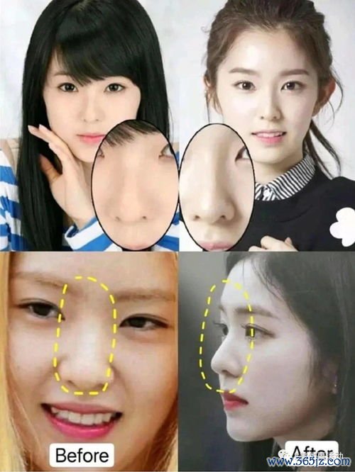 鼻子整形哪里好？鼻子整形与鼻综合修复医院的推荐与选择