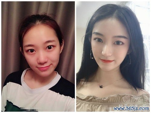 整形,鼻子,手术,方式,解析