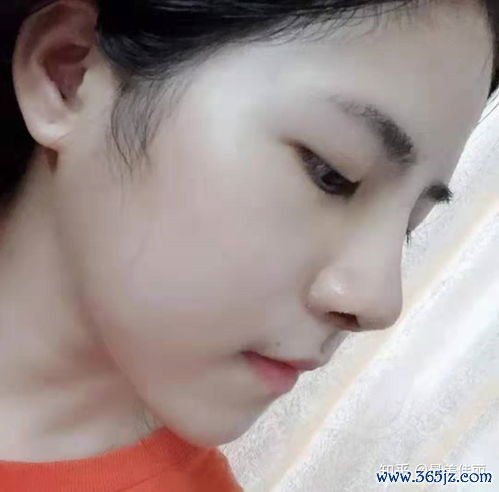 鼻子整形需要多少钱？鼻子整形需要多少钱与不同医院、医生差异