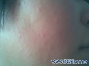 婴儿湿疹：脸上长疹子痒
