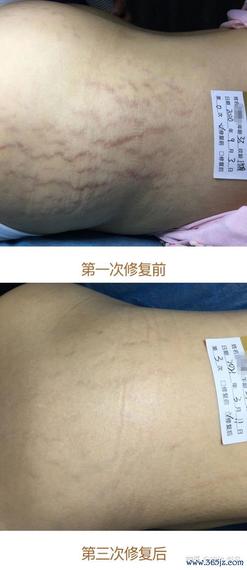 妊娠纹：肚子上的纹，能消吗