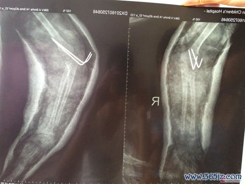 小儿骨折：青枝骨折