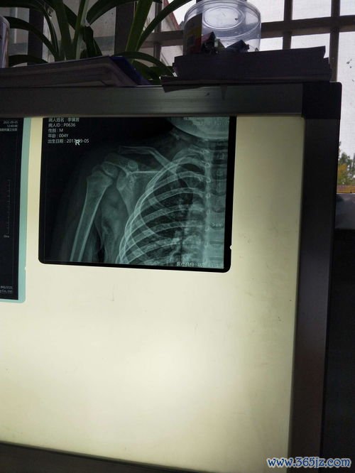 小儿骨折：青枝骨折