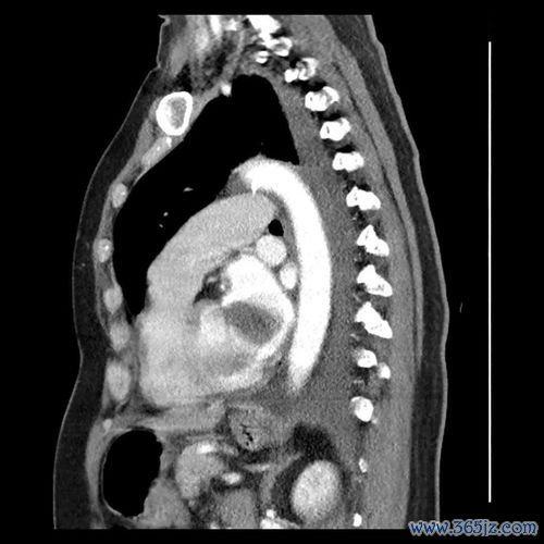 纤维肉瘤-躯干软组织肿块，病理梭形细胞