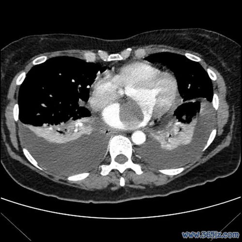 纤维肉瘤-躯干软组织肿块，病理梭形细胞