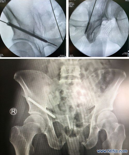 尿道下裂成形术：重建尿道
