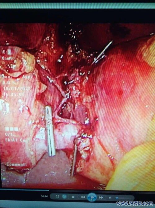 巨结肠手术：切掉没神经的肠子