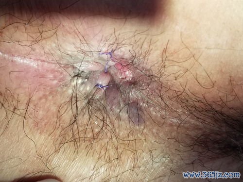 巨结肠手术：切掉没神经的肠子