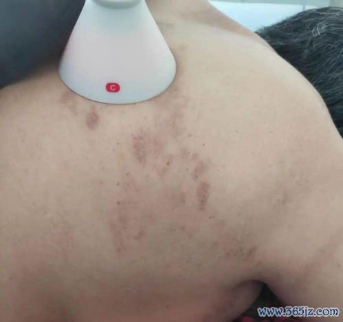 带状疱疹：腰上一圈泡，疼得要命