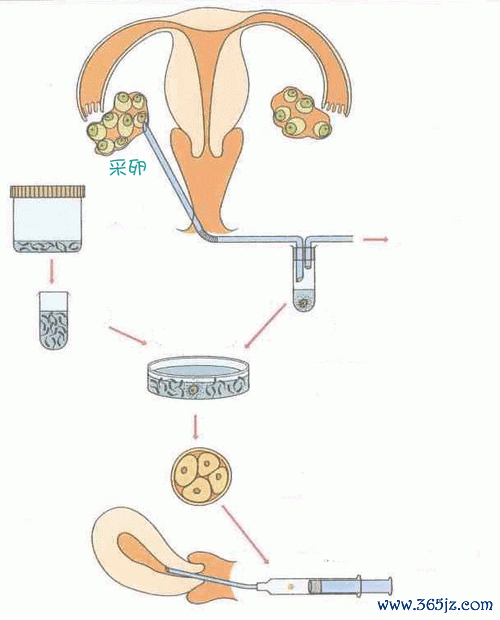 做试管婴儿的具体步骤