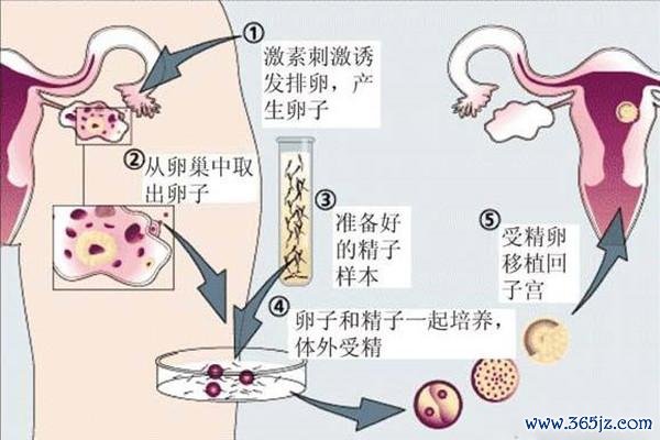 做试管婴儿的办法