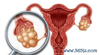 多囊卵巢综合征怎么减肥