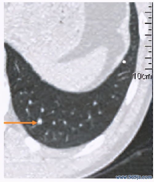 查出肺结节先别慌,这样吃有助于消散 查出肺结节先别慌,这样吃有助于消散