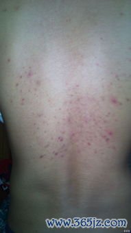 线状硬斑病-线状皮肤硬化