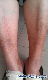 线状硬斑病-线状皮肤硬化