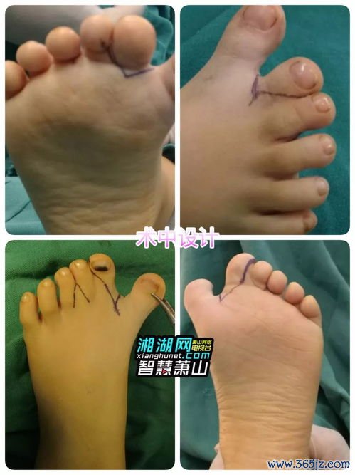 并指畸形：连在一起的手指分开