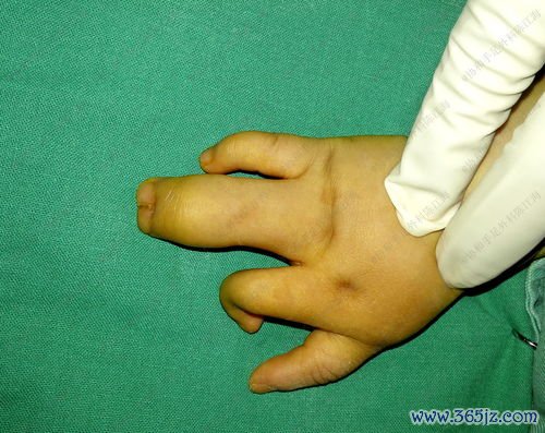 并指畸形：连在一起的手指分开