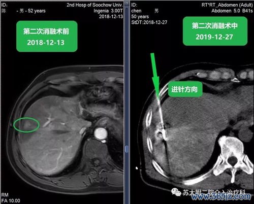微波消融：微波加热烧死肿瘤